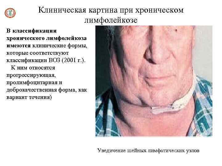 Клиническая картина при хроническом лимфолейкозе В классификации хронического лимфолейкоза имеются клинические формы, которые соответствуют