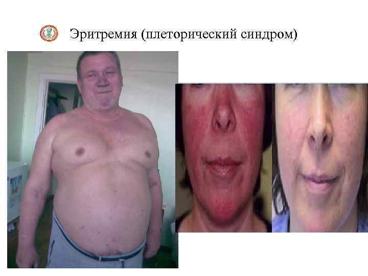 Эритремия (плеторический синдром) 