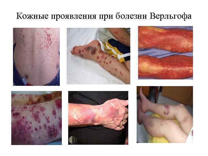 Кожные проявления при болезни Верльгофа 