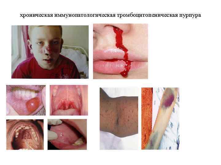 хроническая иммунопатологическая тромбоцитопеническая пурпура 