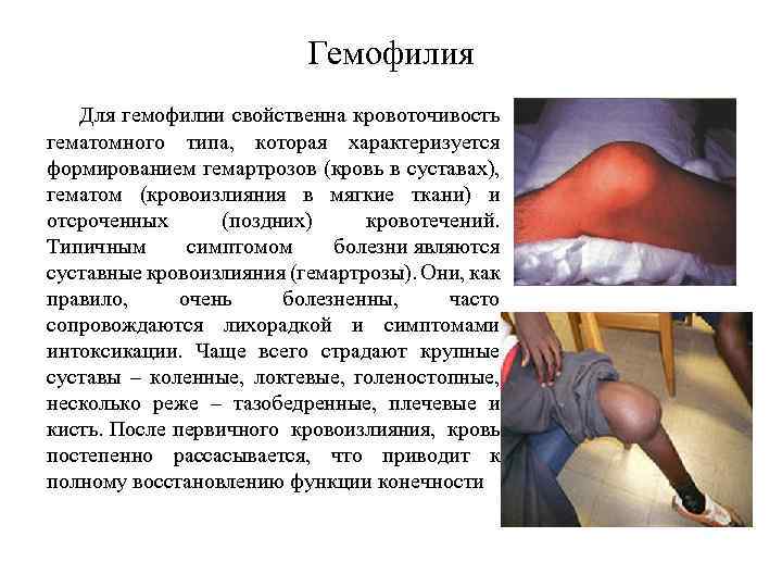 Гемофилия Для гемофилии свойственна кровоточивость гематомного типа, которая характеризуется формированием гемартрозов (кровь в суставах),