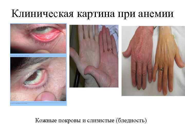 Клиническая картина при анемии Кожные покровы и слизистые (бледность) 