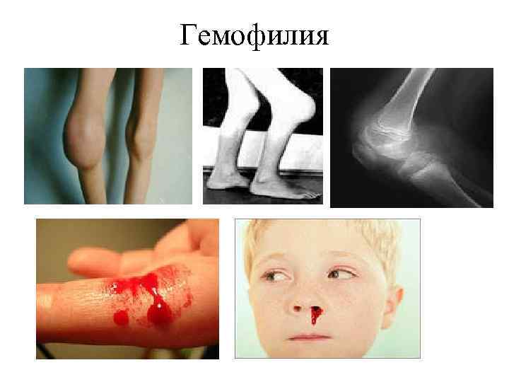 Гемофилия 