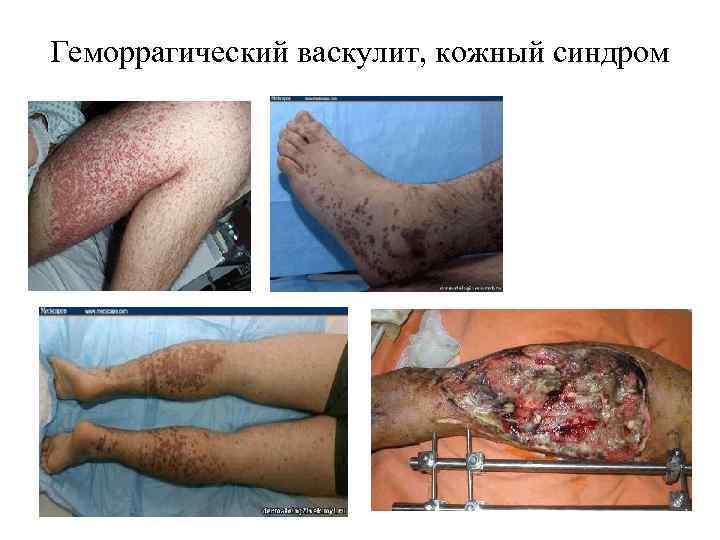 Геморрагический васкулит, кожный синдром 