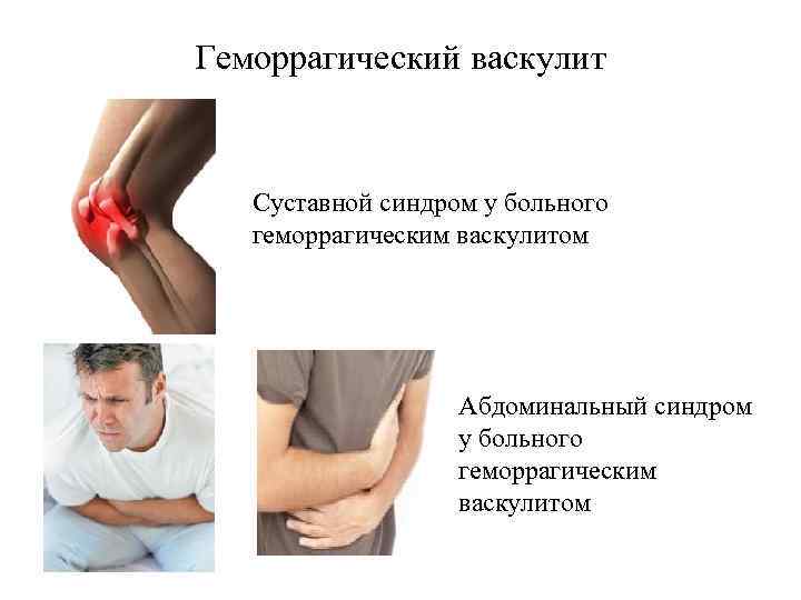 Геморрагический васкулит Суставной синдром у больного геморрагическим васкулитом Абдоминальный синдром у больного геморрагическим васкулитом