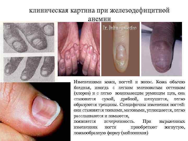 клиническая картина при железодефицитной анемии Изменениями кожи, ногтей и волос. Кожа обычно бледная, иногда