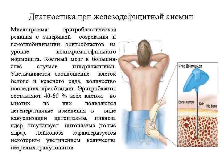 Диагностика при железодефицитной анемии Миелограмма: эритробластическая реакция с задержкой созревания и гемоглобинизации эритробластов на