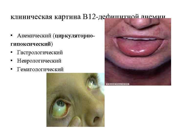 клиническая картина В 12 -дефицитной анемии • Анемический (циркуляторногипоксический) • Гастрологический • Неврологический •