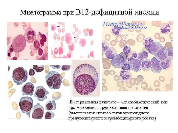 Фолиеводефицитная анемия картинки