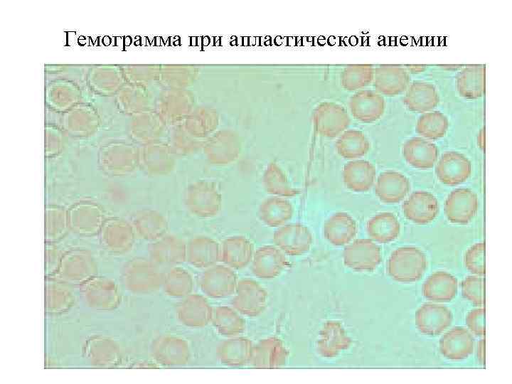 Апластическая анемия картина крови