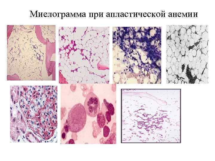 Миелограмма при апластической анемии 