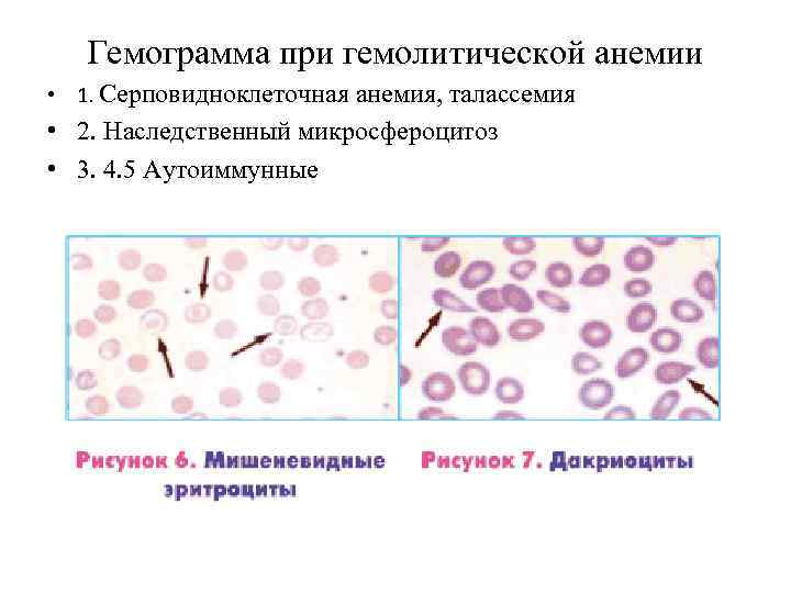 Гемолитическая анемия картина крови