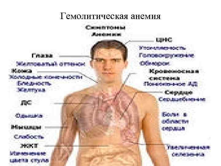 Гемолитическая анемия 