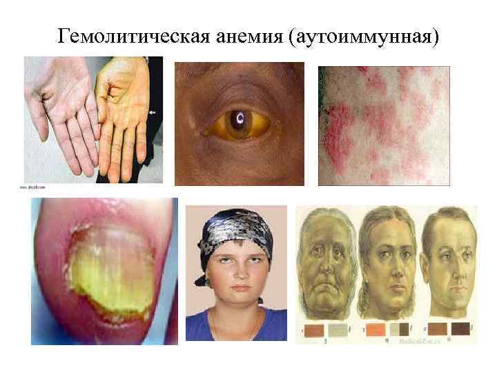 Гемолитическая анемия (аутоиммунная) 