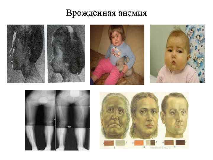Врожденная анемия 