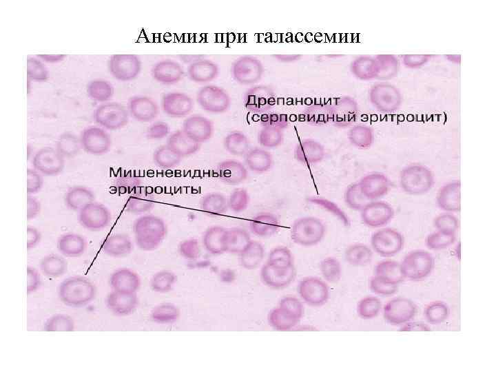 Анемия при талассемии 