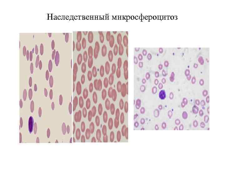 Наследственный микросфероцитоз 