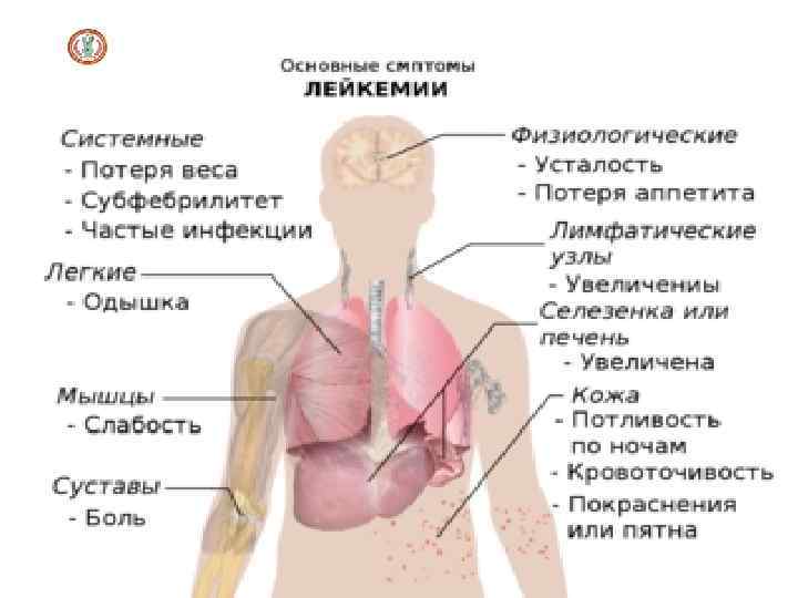 Клиническая картина острых лейкозов 