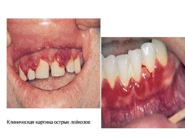 Клиническая картина острых лейкозов 