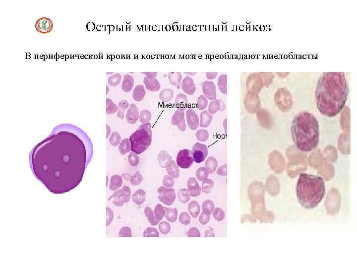 Картина крови при хроническом миелолейкозе