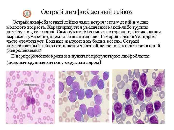 Лимфобластный лейкоз. Лимфобластный лейкоз гистология. Острый миелоидный и лимфобластный лейкоз. Острый лимфобластный лейкоз миелограмма. Острый недифференцированный лейкоз костный мозг.