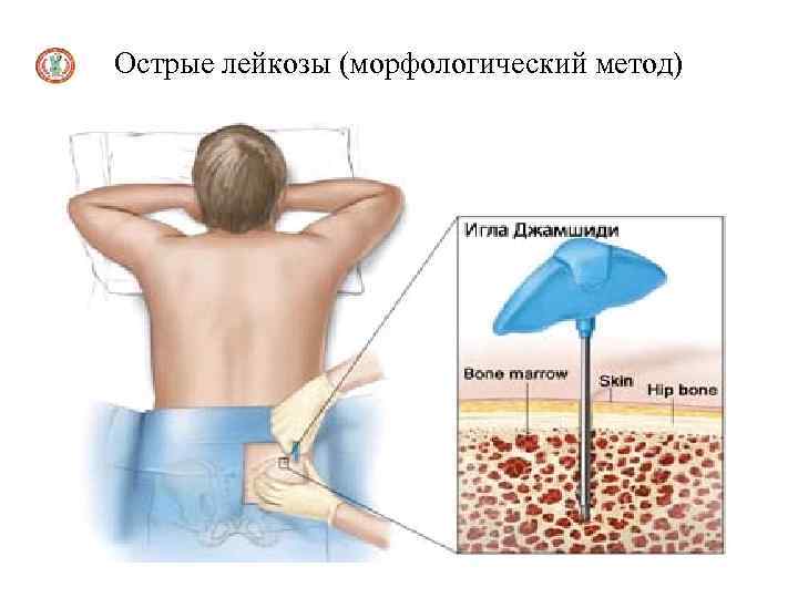 Острые лейкозы (морфологический метод) 