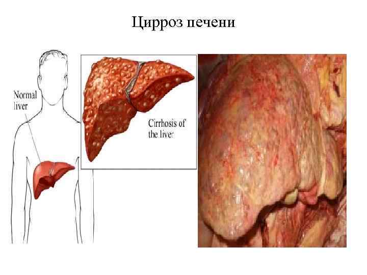 Цирроз печени 