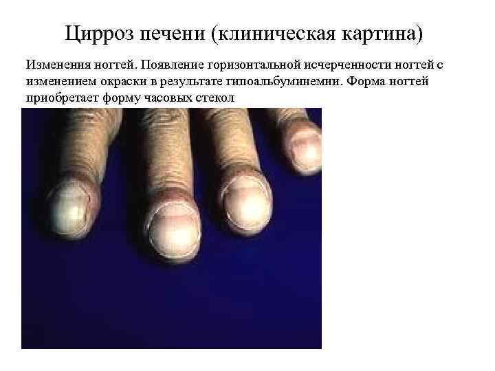 Цирроз печени (клиническая картина) Изменения ногтей. Появление горизонтальной исчерченности ногтей с изменением окраски в