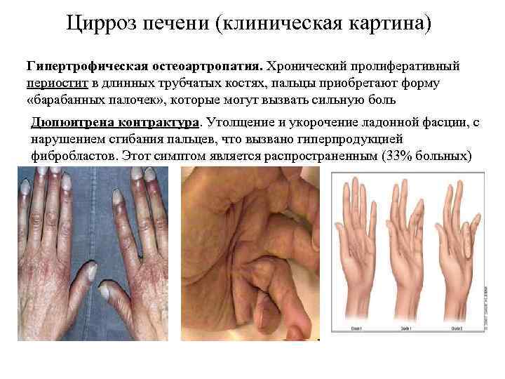 Цирроз печени (клиническая картина) Гипертрофическая остеоартропатия. Хронический пролиферативный периостит в длинных трубчатых костях, пальцы
