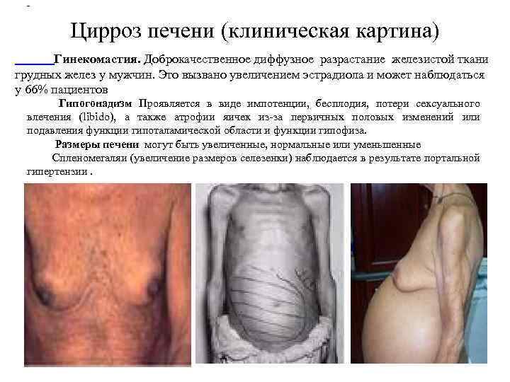 - Цирроз печени (клиническая картина) Гинекомастия. Доброкачественное диффузное разрастание железистой ткани грудных желез у