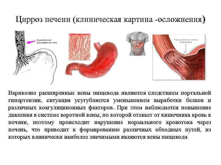 Цирроз печени (клиническая картина -осложнения) Варикозно расширенные вены пищевода являются следствием портальной гипертензии, ситуация