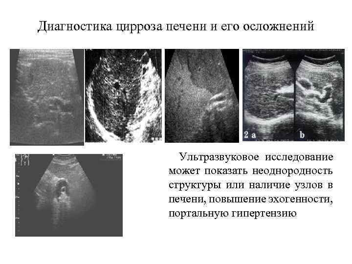 Диагностика цирроза печени и его осложнений Ультразвуковое исследование может показать неоднородность структуры или наличие