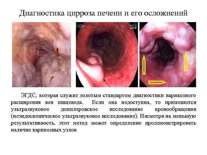 Диагностика цирроза печени и его осложнений ЭГДС, которая служит золотым стандартом диагностики варикозного расширения