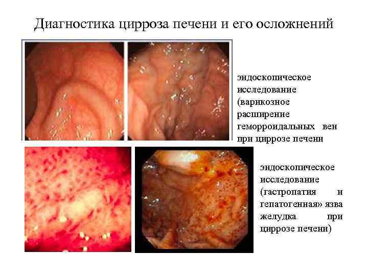 Диагностика цирроза печени и его осложнений эндоскопическое исследование (варикозное расширение геморроидальных вен при циррозе