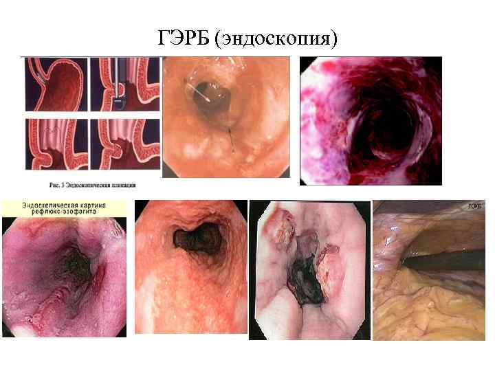 ГЭРБ (эндоскопия) 