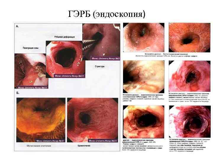 ГЭРБ (эндоскопия) 