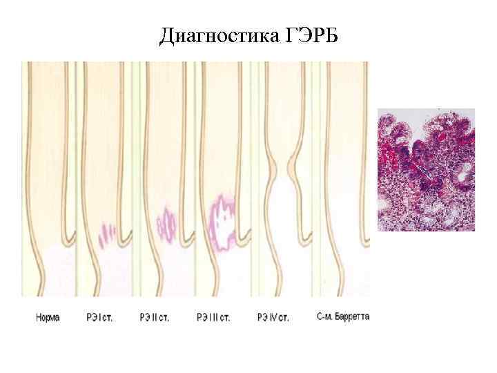 Диагностика ГЭРБ 