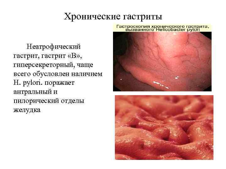 Хронические гастриты Неатрофический гастрит, гастрит «В» , гиперсекреторный, чаще всего обусловлен наличием H. pylori.