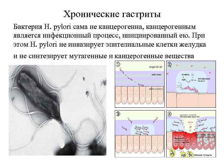 Хронические гастриты Бактерия H. pylori сама не канцерогенна, канцерогенным является инфекционный процесс, инициированный ею.