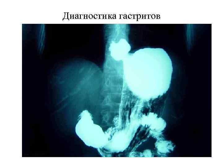 Грыжа пищевода рентген. Рентгеноскопия желудка грыжа. Рентгенография желудка ГЭРБ.