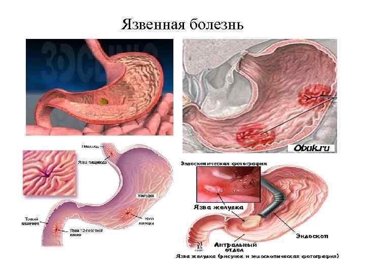 Язвенная болезнь 