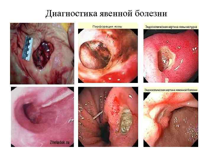 Диагностика явенной болезни 