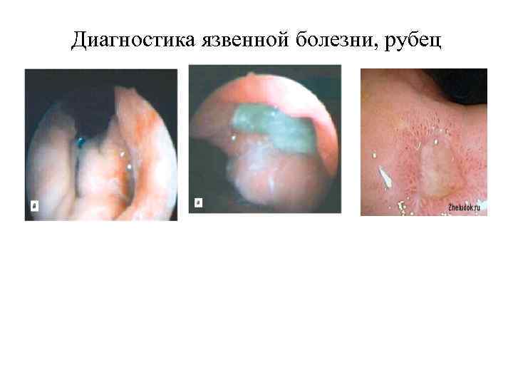 Диагностика язвенной болезни, рубец 