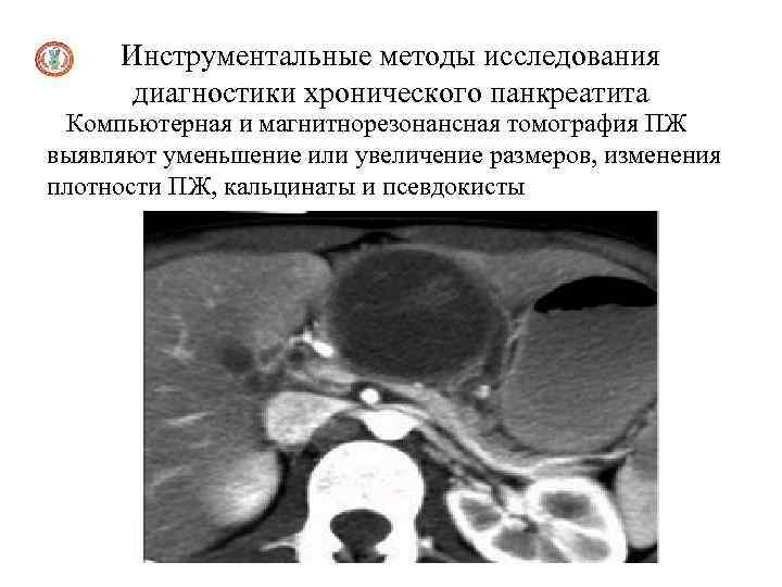 Инструментальные методы исследования диагностики хронического панкреатита Компьютерная и магнитнорезонансная томография ПЖ выявляют уменьшение или