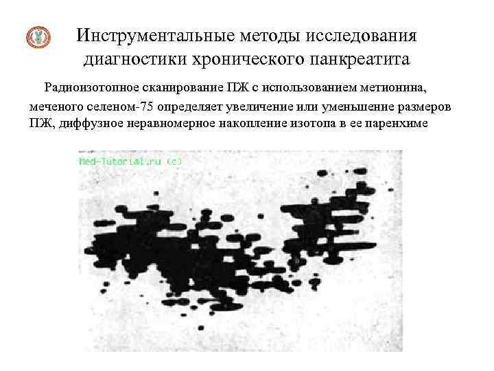 Инструментальные методы исследования диагностики хронического панкреатита Радиоизотопное сканирование ПЖ с использованием метионина, меченого селеном-75