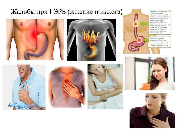 Жалобы при ГЭРБ (жжение и изжога) 