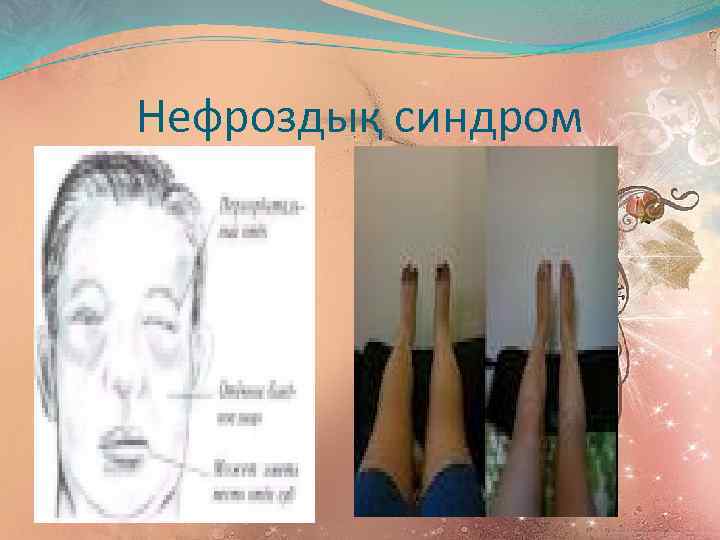 Нефроздық синдром 