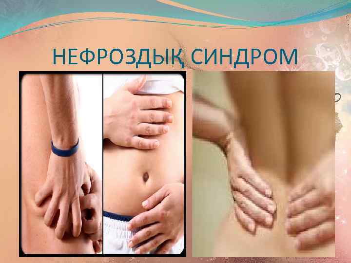 НЕФРОЗДЫҚ СИНДРОМ 