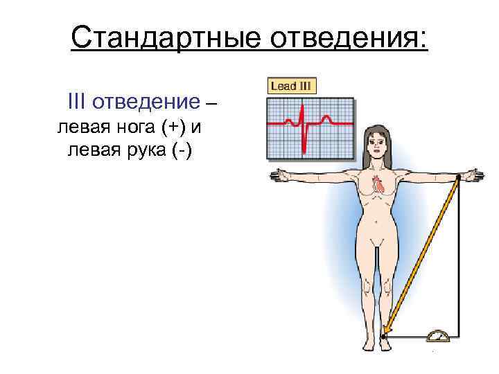 Стандартные отведения: III отведение – левая нога (+) и левая рука (-) 