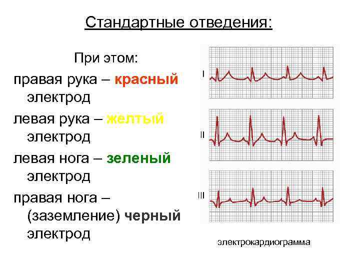 Стандартные отведения: При этом: правая рука – красный электрод левая рука – желтый электрод